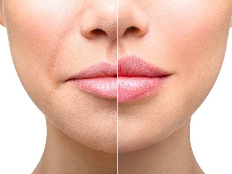 Почему с возрастом губы становятся тоньше и как вернуть им объём