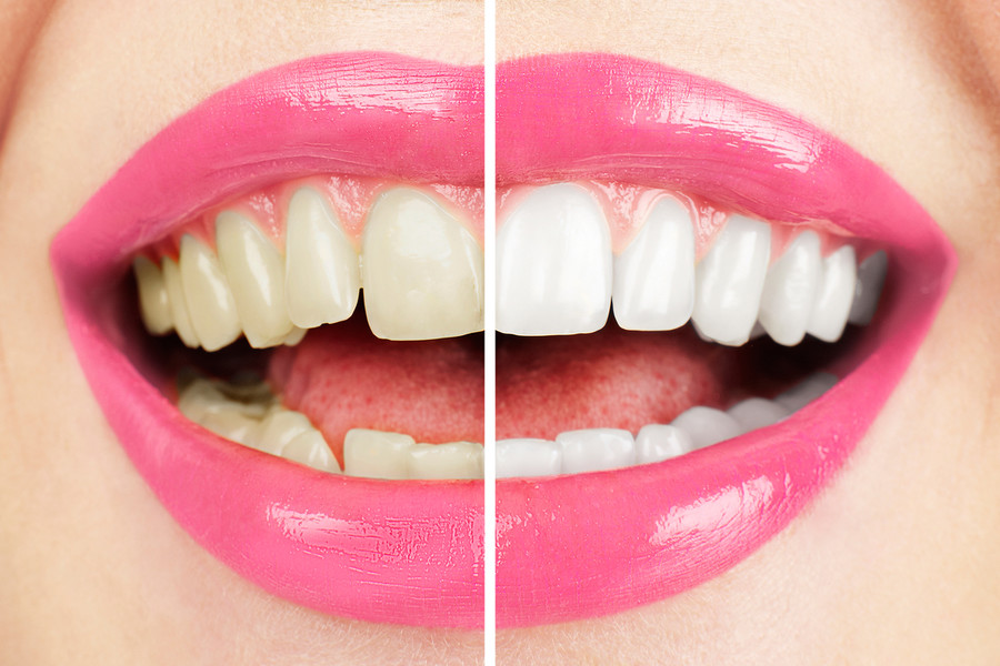3 безопасных способа отбелить зубы в домашних условиях