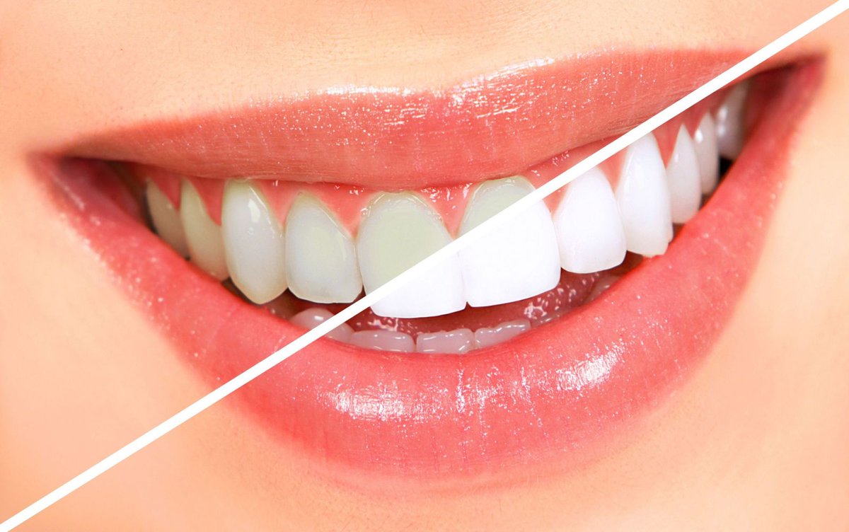 3 безопасных способа отбелить зубы в домашних условиях