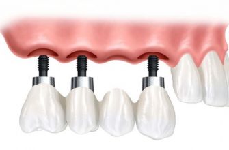 Основные виды и особенности имплантов зубов